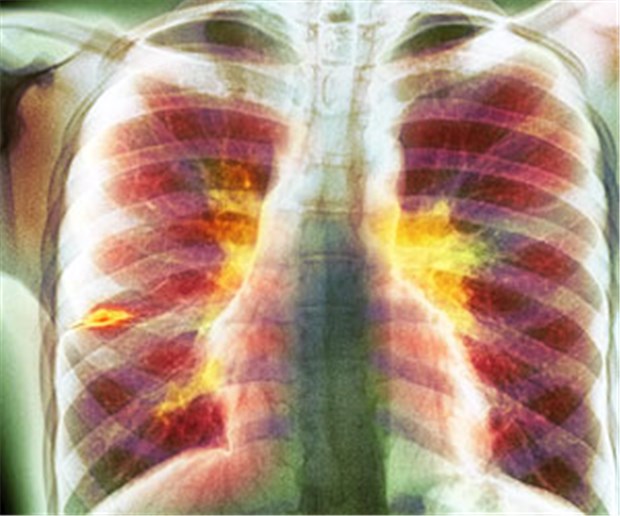Infizierte Kinder bereiten Sorgen Coloriertes Röntgenbild eines 14-Jährigen mit Tuberkulose: Hervorgehoben sind entzündete Lymphknoten (Lymphadenopathie, gelb) und Flüssigkeit im Lappenspalt rechts (orange).