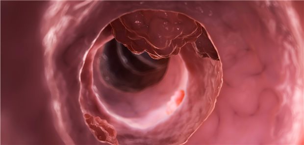 Computer-Darstellung eines Kolorektalkarzinoms. An den Folgen eines solchen Karzinoms sterben jedes Jahr in Deutschland etwa 25.000 Menschen.