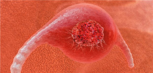 Computer-Darstellung eines Zervixkarzinoms.