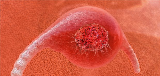 Computer-Darstellung eines Zervixkarzinoms.