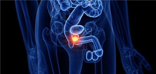 Computerdarstellung von Prostata-Krebs; Gemäß einer Studie haben Patienten mit akutem Harnverhalt ein Jahr lang ein erhöhtes Risiko für Prostatakarzinome.