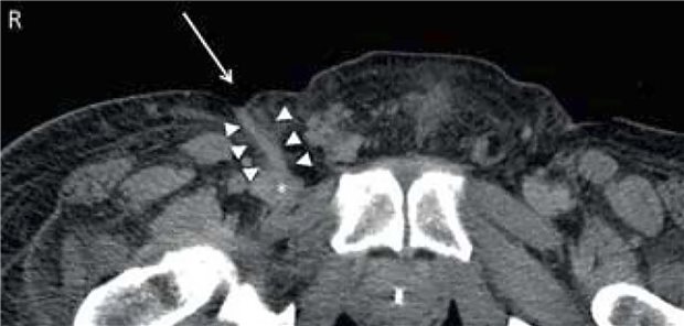 Computertomografie in Axialschichung auf Höhe der Symphyse. Der Pfeil weist auf den Exit des Frankfurter Tunnels, die Pfeilspitzen auf den dermalen Keil hin, der bis zur V. femoralis communis extra (Stern) führt.
