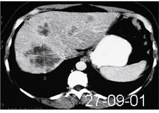 Bessere Prognose bei Lebermetastasen Computertomografische Aufnahmen eines Patienten mit Lebermetastasen eines kolorektalen Karzinoms. Der Patient wurde von 2001 bis 2003 mit Cetuximab plus Irinotecan behandelt.