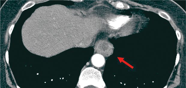 Computertomografische Darstellung (axial) der Raumforderung am distalen Ösophagus mit randständiger Kontrastmittelaufnahme und zentraler Einschmelzung. Roter Pfeil: Raumforderung mit Kontakt zum Ösophagus.