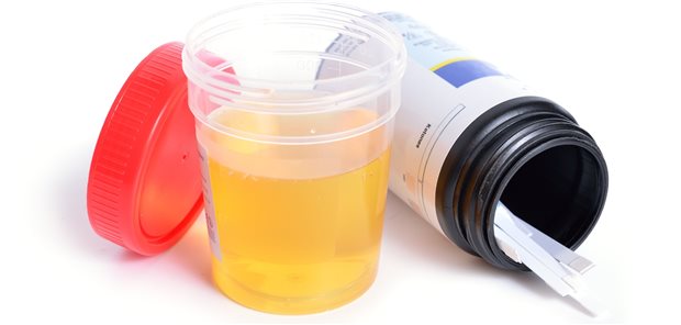 Urinbecher und Teststreifen zum Test auf Mikroalbuminurie