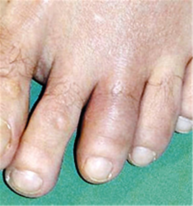 Wenn entzündliches Rheuma auf Magen und Leber trifft Daktylitis ("Wurstzeh") als extraintestinales Symptom einer chronisch-entzündlichen Darmerkrankung.