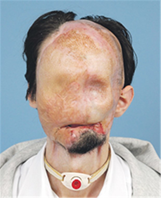 Erstmals komplettes Gesicht in den USA transplantiert Dallas Wiens im Dezember vor der Operation: Augen, Nase und Lippen hatte er beim Unfall verloren.