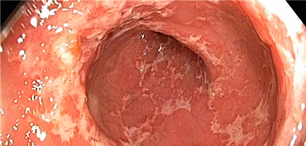 Darm-Schleimhaut bei Colitis ulcerosa: Die neue Leitlinienfassung zu der CED ist nun online.