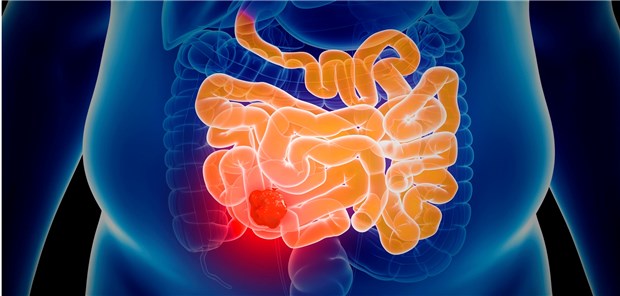 Darmkrebs: Jede Blutung aus dem unteren Gastrointestinaltrakt ist als Warnhinweis abzuklären!