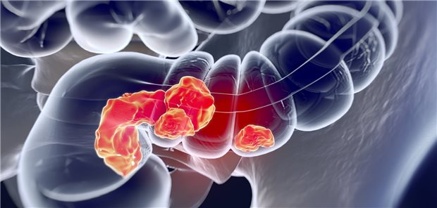 Darmkrebs: Neue Arzneien und Arznei-Kombinationen erweitern die Optionen auch für Patienten mit metastasiertem Karzinom.