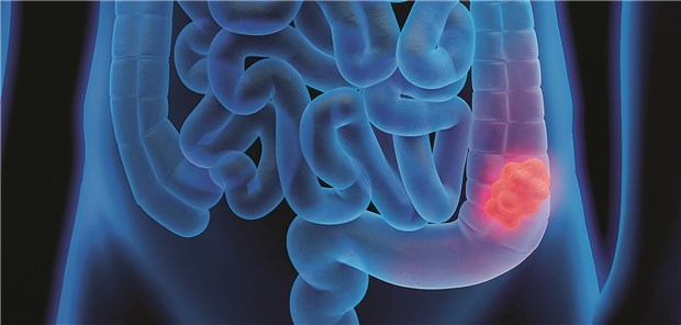 Fibromatose täuscht Darmkrebsrezidiv vor