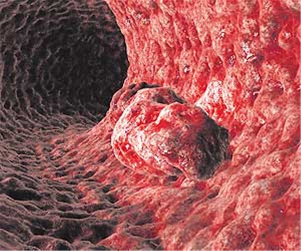 Vorsorge-Koloskopie nur noch alle 20 Jahre? Darmkrebs-Vorstufe Polyp in der Koloskopie.