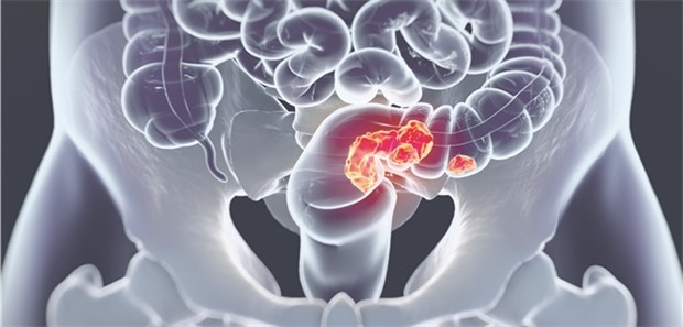 Koloskopien könnten noch mehr Leben retten Darmkrebs im Modell: Neue immunologische Tests verbessern die Vorsorge.