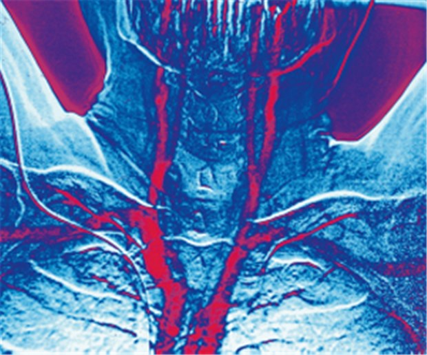 Darstellung der Halsschlagadern in der Angiografie.