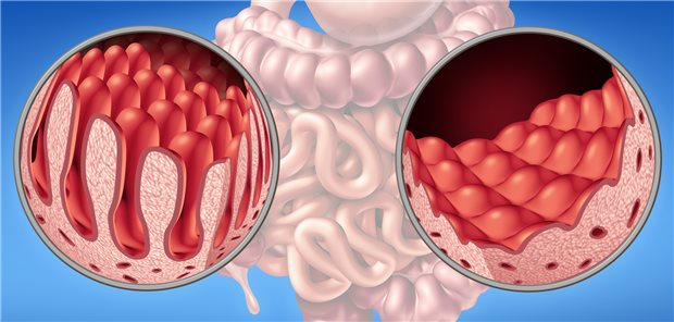 Darstellung der für Zöliakie typischen Zottenatrophie (rechts) im Dünndarm.