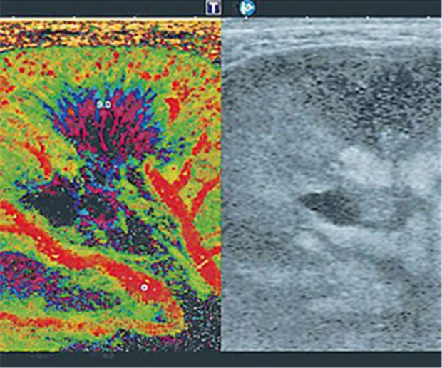 Ein neuer Konkurrent für CT und MRT Darstellung der physiologischen Nierenperfusion im Kontrastmittel-Ultraschall. Die Kontrastmittel-Gabe macht den Gefäßbaum der Niere in hoher Auflösung sichtbar (links).