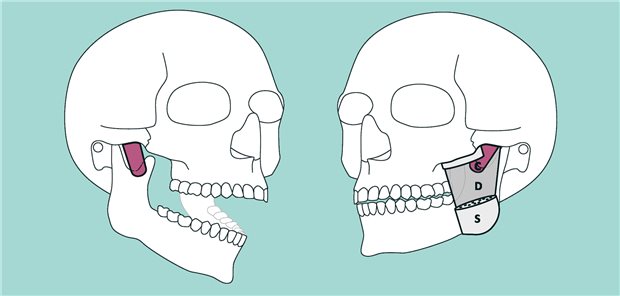 Darstellung des Schädels: violett hervorgehoben ist die dritte Schicht (C) des Masseters, die ein Forscherteam nun beschrieben hat (S = oberflächlicher Teil des Masseters; D = Tiefer Teil des Masseters).