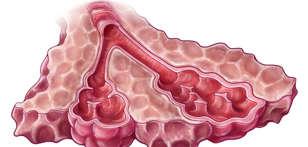 Darstellung des Wabenmusters einer Lungenfibrose. Das überschüssige Gewebe erschwert zunehmend den Gasaustausch in der Lunge.