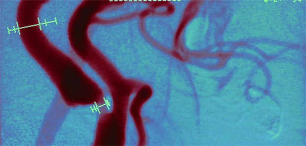 Jeder Dritte mit Karotisstent ist nach zwei Jahren tot Darstellung einer filiformen Stenose der Arteria carotis in der MRT-Angiografie.