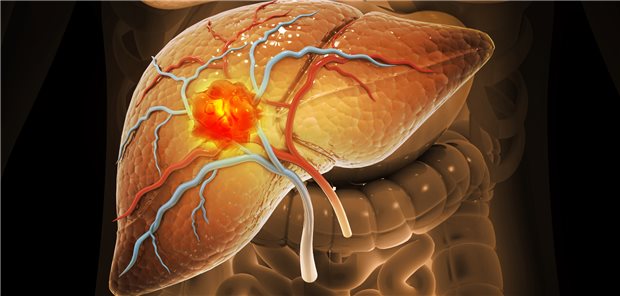 Darstellung eines Leberkarzinoms: Vorliegen einer Alkoholleber und Krebsrisiko sind miteinander assoziiert.

