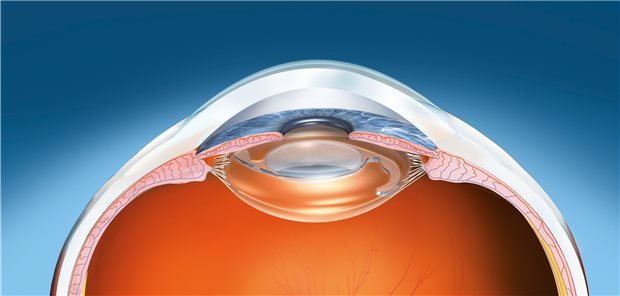 Darstellung eines menschlichen Auges mit einer Kunstlinse.