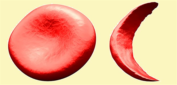 Darstellung normaleErythrozyten und deformierte rote Blutkörperchen bei Sichelzellanämie. Auch hier können Forscher mittels Gentherapie erste Erfolge melden.