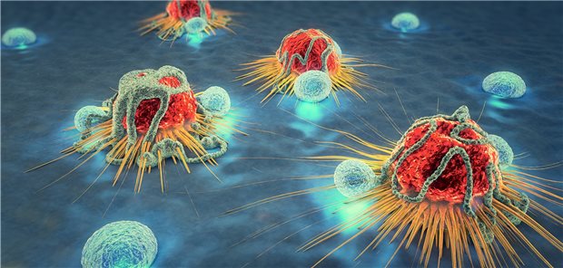 Darstellung von Krebszellen und Lymphozyten. Molekulare Veränderungen in den Krebszellen spürt ein neuer Algorithmus auf. Diese Daten können für weitere Therapieoptionen genutzt werden.