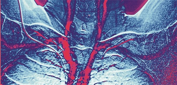 Schlechter Schlaf ist riskant für die Gefäße Darstellungen der Halsschlagadern in der Angiografie.