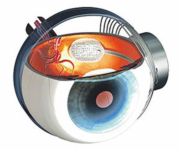Augenärzte setzen auf Chips und Gentherapie Das ARGUS II-Implantat der US-amerikanischen Firma Second Sight wird auf die Netzhautoberfläche implantiert.