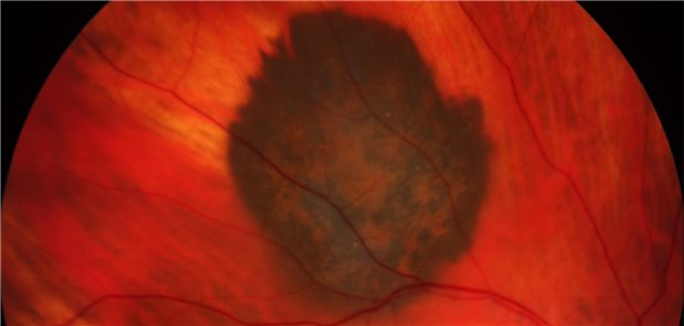 Das Aderhautmelanom zeichnet sich dunkel gegen das gesunde Gewebe des Augenhintergrundes ab.