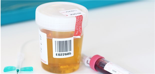 Taugt die Urinprobe zur Krebsdiagnostik? Das CAU-Forschungsteam möchte zur Krebsdiagnose künftig Urin statt Blut verwenden.