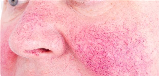 Rosazea: Die Prävalenz der Hauterkrankung nahm mit dem Alter signifikant zu.