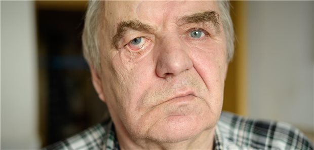 Älterer Mann mit Gesichtsnervenlähmung aufgrund des Eagle-Syndroms.