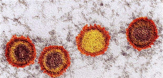 Das Epstein-Barr-Virus löst nicht nur infektiöse Mononukleose aus. Es wird auch aufgrund seines hohen onkogenen Potenzials und seiner Verbindung zu verschiedenen lymphatischen und epithelialen Krebsarten als Karzinogen der Gruppe 1 eingestuft. (angefärbte transmissionselektronenmikroskopische Aufnahme)&#xA;