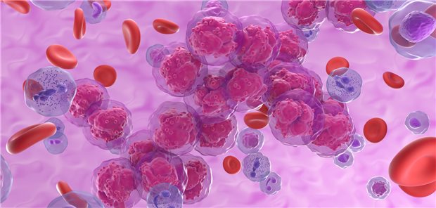 Das Fazit der Ärzte um Dr. Arnon Kater ist, dass die Studie VENICE-1 zeigt, dass die Venetoclax-Monotherapie eine tiefe und anhaltende Response bei rezidivierter oder refraktärer chronisch lymphatischer Leukämie hervorrufen kann – auch unter Patienten mit BCR-Hemmer-Vortherapie.