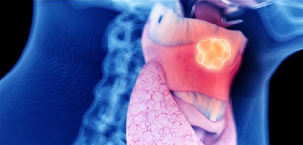 Das Fazit von Horton und Mitarbeitenden: Bei mäßiger Dysplasie ist das Transformationsrisiko bereits erheblich erhöht, es sei daher nicht ratsam, leichte und moderate Dysplasien in einer Risikogruppe zusammenzufassen. Zudem sollten moderate Dysplasien besser überwacht werden.