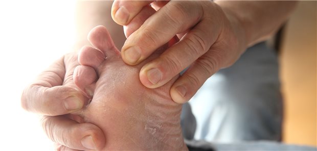 Das Hand-Fuß-Syndrom gehört zu den häufigen kutanen Nebenwirkungen einer Chemotherapie.