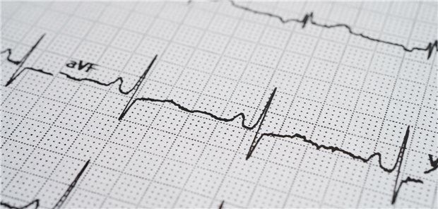Ausdruck des Elektrokardiogrammes (EKG) eines Patienten.