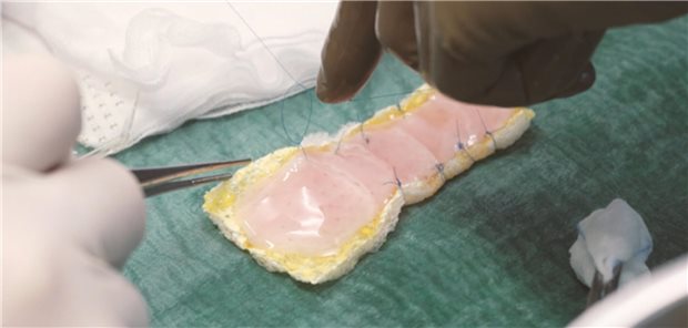 Das Herzpflaster wird für die Operation vorbereitet.