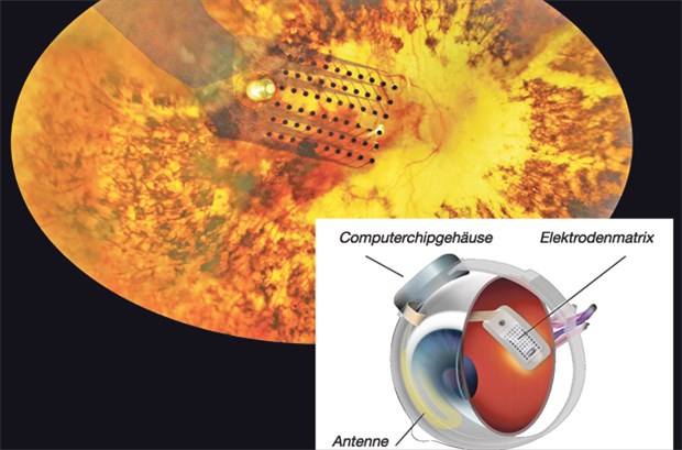 Das Implantat auf der Netzhaut und im Modell: Impulse einer Minikamera werden von Elektroden auf Netzhautzellen übertragen.
