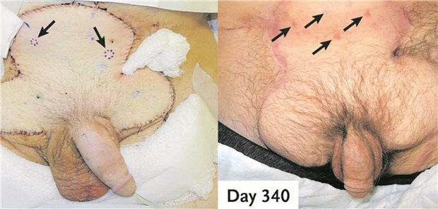 Das Implantat postoperativ an den Tagen 15 und 340. Das Gewebe heilte ohne Zeichen von Abstoßungsreaktionen ein. Die Pfeile zeigen Stellen von Biopsie-Entnahmen.