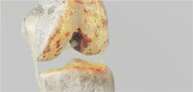 Das Interventionspaket hat laut den Autoren und Autorinnen vor dem geplantem Gelenkersatz bei Gonarthrose Potenzial, zumal sich zehn Prozent der 40 Personen in der Interventionsgruppe schließlich gegen die Operation entschieden, weil die Symptome nachgelassen hatten.