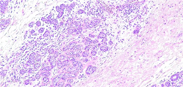 Mikroskopische Ansicht einer fibrosierenden Brustadenose nach Hämatoxylin-Eosin-Färbung.