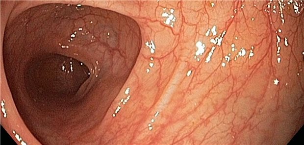 Das Kolon erscheint oft endoskopisch normal bei mikroskopischer Kolitis.