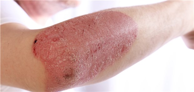 Das Krebsrisiko von Psoriasis-Patienten aller Schweregrade war in der Metaanalyse um 18 Prozent gegenüber Personen ohne die Hauterkrankung erhöht 