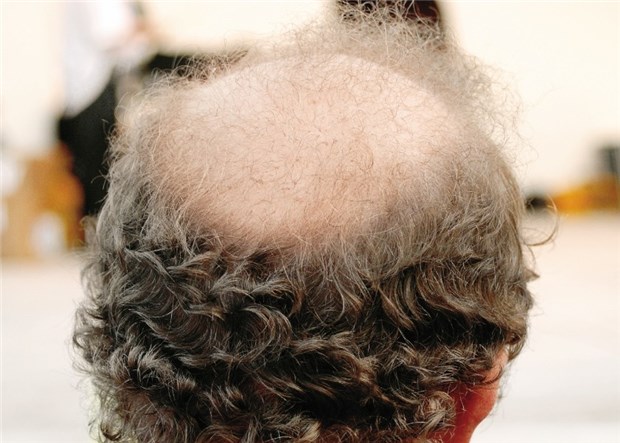 Bei Haarausfall ist Resignation fehl am Platz Das Lichten des Haarschopfs macht vor allem jüngeren Männern zu schaffen.
