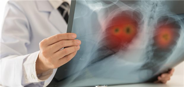 Arzt mit Brustkorb-Röntgenaufnahme