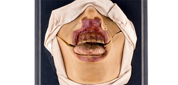 Ekelhafte Lehrmittel Das Museum der Universität Tübingen zeigt die Sonderausstellung "Krankheit als Kunst(form) - Moulagen der Medizin".