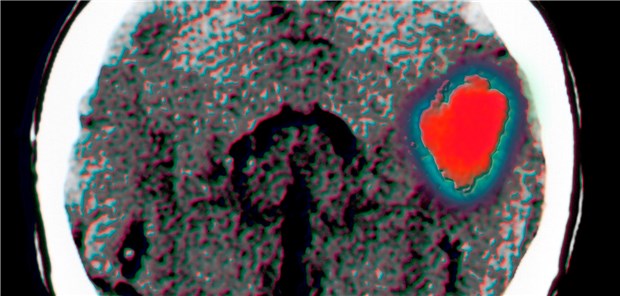 Das Risiko-Nutzen-Profil von Antithrombotika bei Patienten mit Hirnblutung ist ähnlich wie bei solchen ohne Blutung.