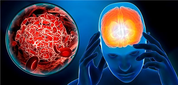 Hirnvenenthrombosen: Risiko nach Infektion deutlich größer als nach Impfung Hirnvenenthrombose: Das Risiko, daran zu erkranken, ist in den ersten zwei Wochen nach einer Infektion mit SARS-CoV-2 laut einer Studie etwa 100-mal so hoch wie in der gesunden Allgemeinbevölkerung.